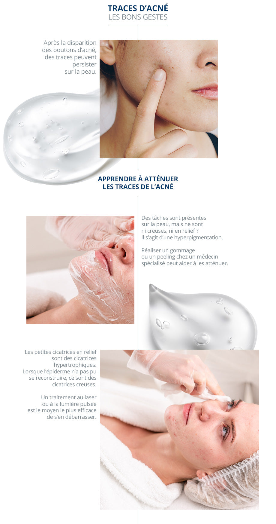 Les effets du soleil sur les cicatrices d’acné