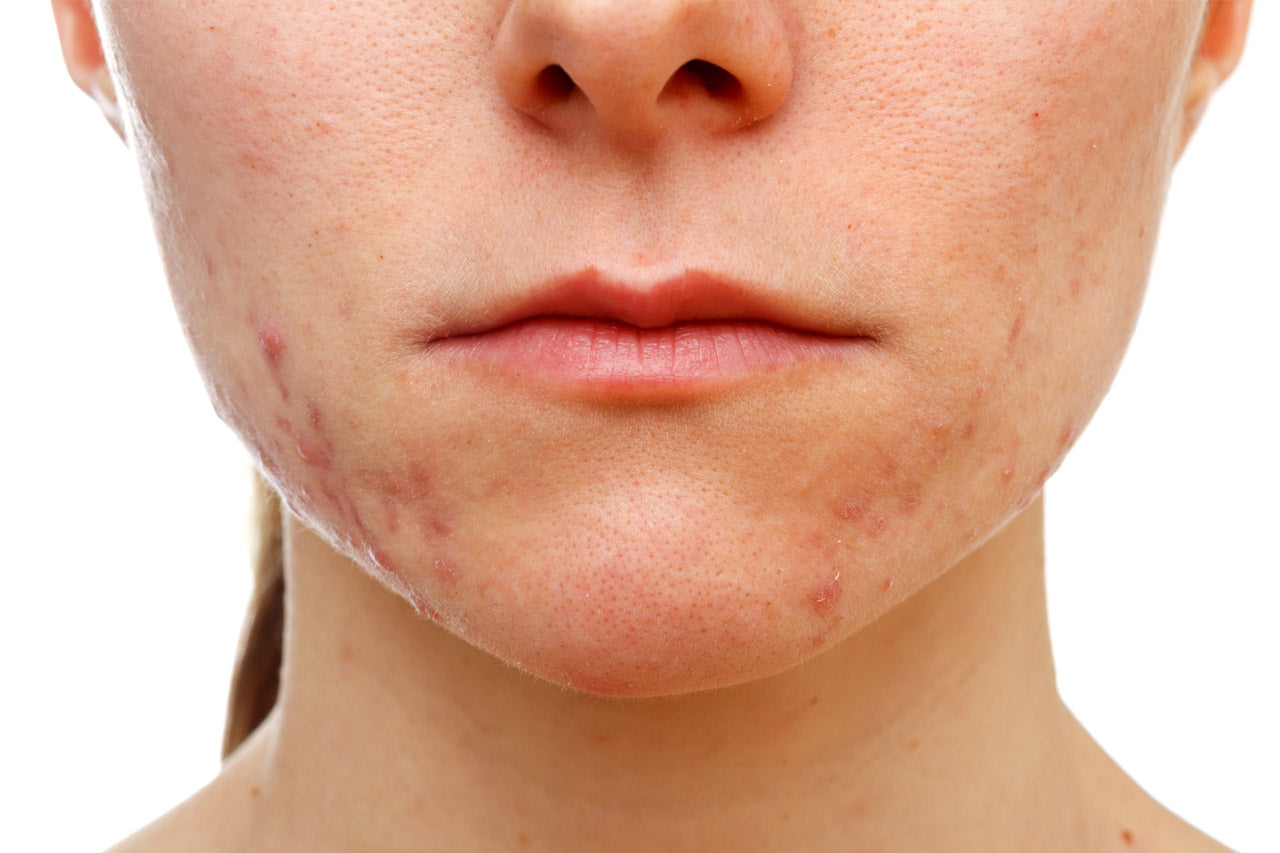 Comment éviter et soigner une cicatrice après une brûlure ?