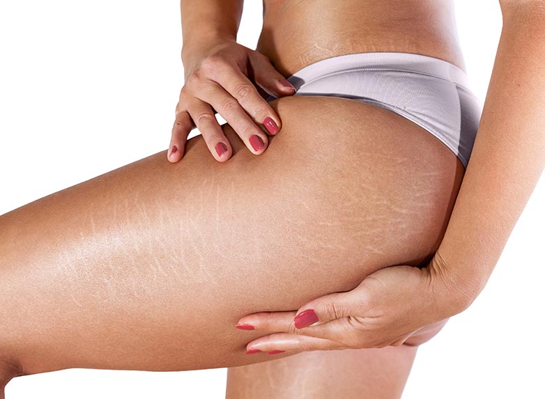 Vergetures sur le fessier : comment les enlever ?