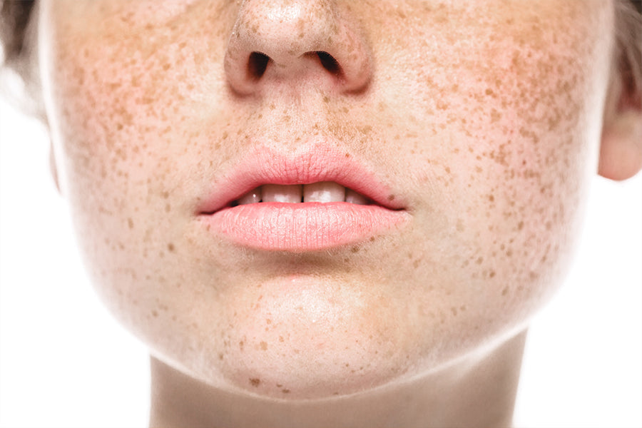 Quels sont les effets du soleil sur les taches de rousseur ?