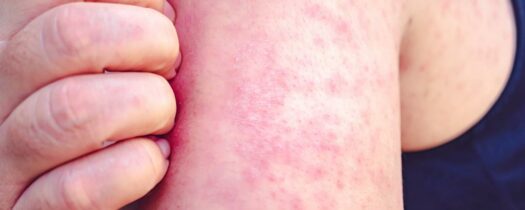 Comment prévenir l’apparition de boutons de chaleur ?