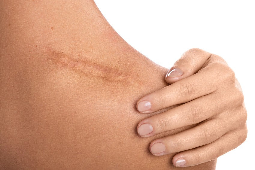 Comment éviter et soigner une cicatrice après une brûlure ?