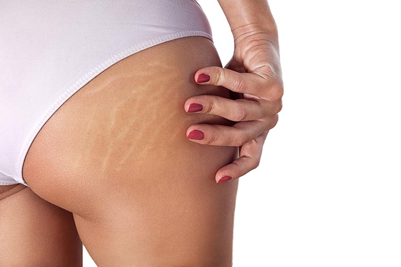 Crème contre les vergetures : nos conseils pour plus d’efficacité
