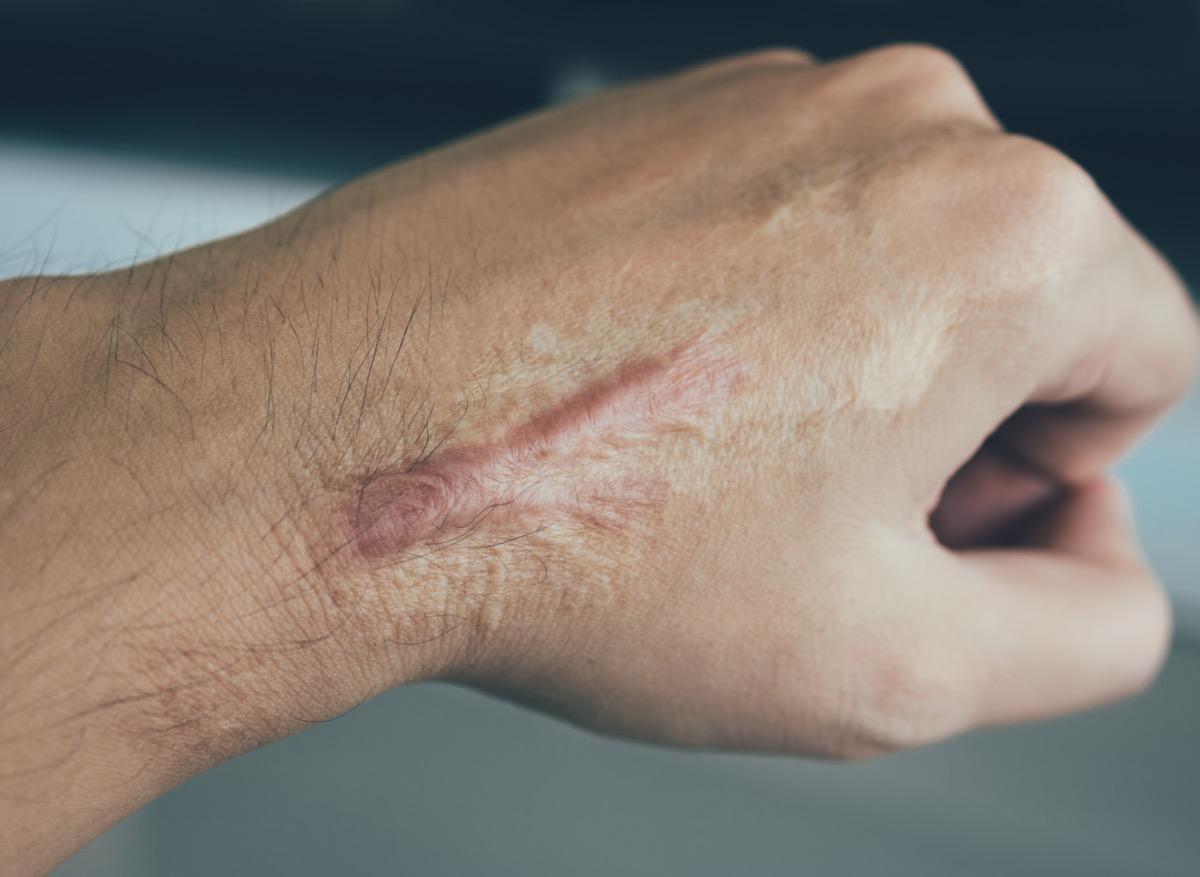 Brûlure : comment prévenir l’apparition d’une cicatrice ?