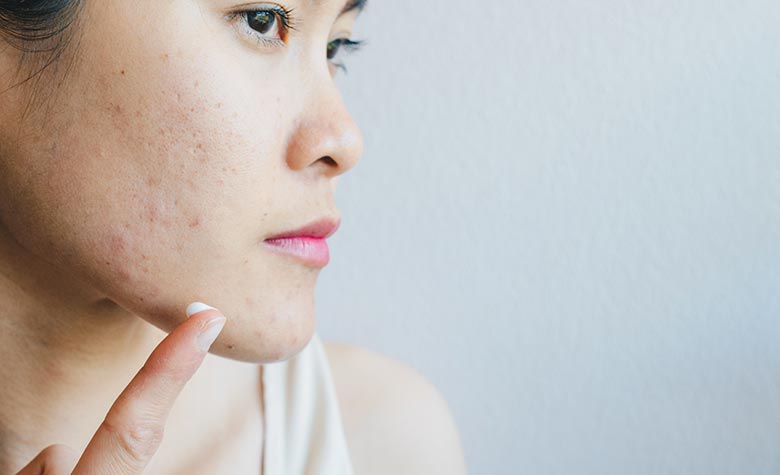 Peau fine et cicatrice : nos conseils de soin