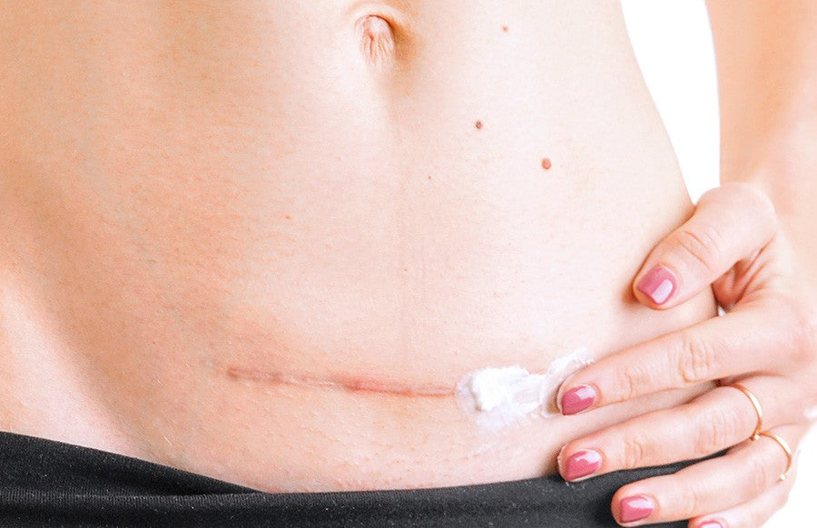 Après la grossesse : comment prendre soin de sa cicatrice de césarienne