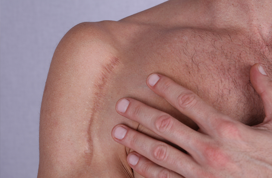Cicatrice chéloïde : traitement des cicatrices
