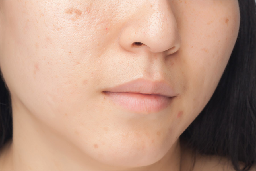 Crème pour les cicatrices d'acné : comment agit-elle ? - Saint ...