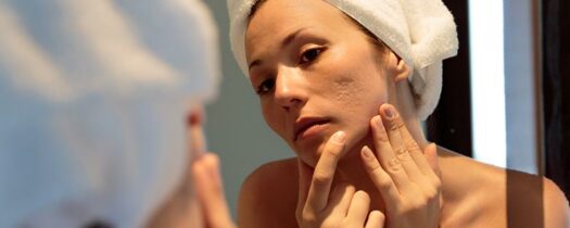 Cicatrices sur le visage : quelles sont les solutions pour les atténuer ?